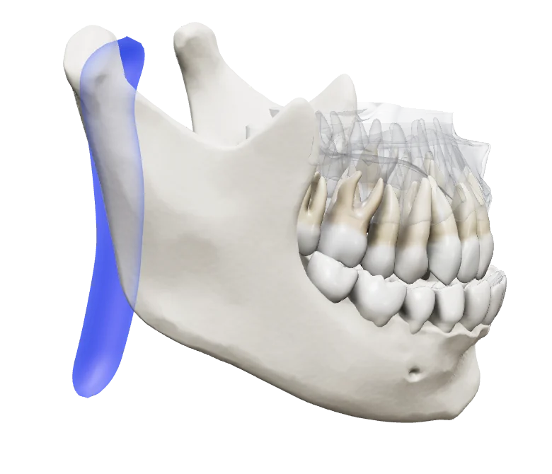 Mandible advanced by an appliance: the same airway stays open.
