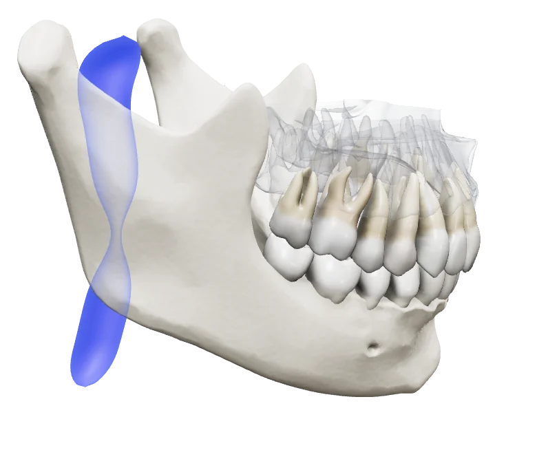Mandible in its retruded position: the airway behind the tongue narrows to a waist.